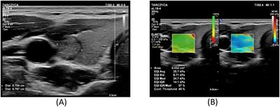 Application of shear wave elastography in the management of thyroid nodules in children and adolescents: our experience and a review of the literature